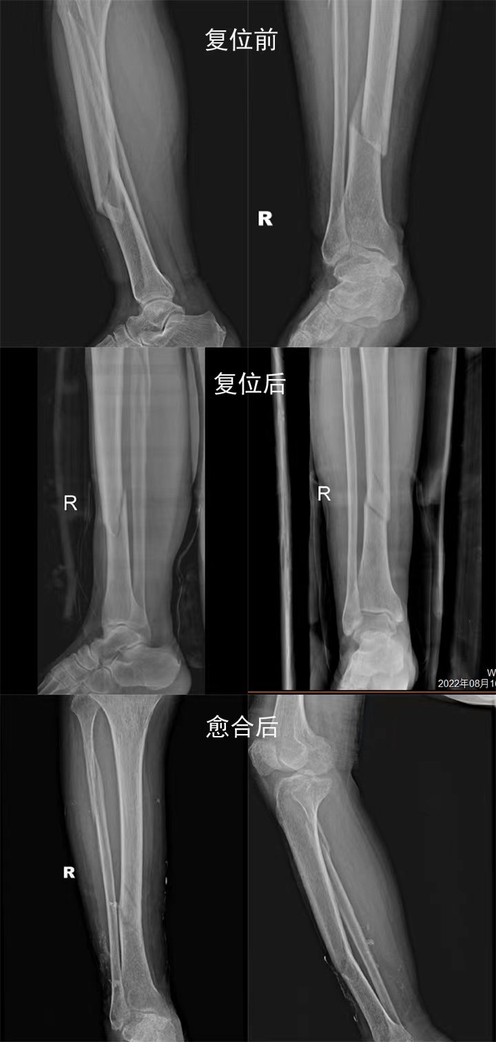 胫腓骨骨折.jpg